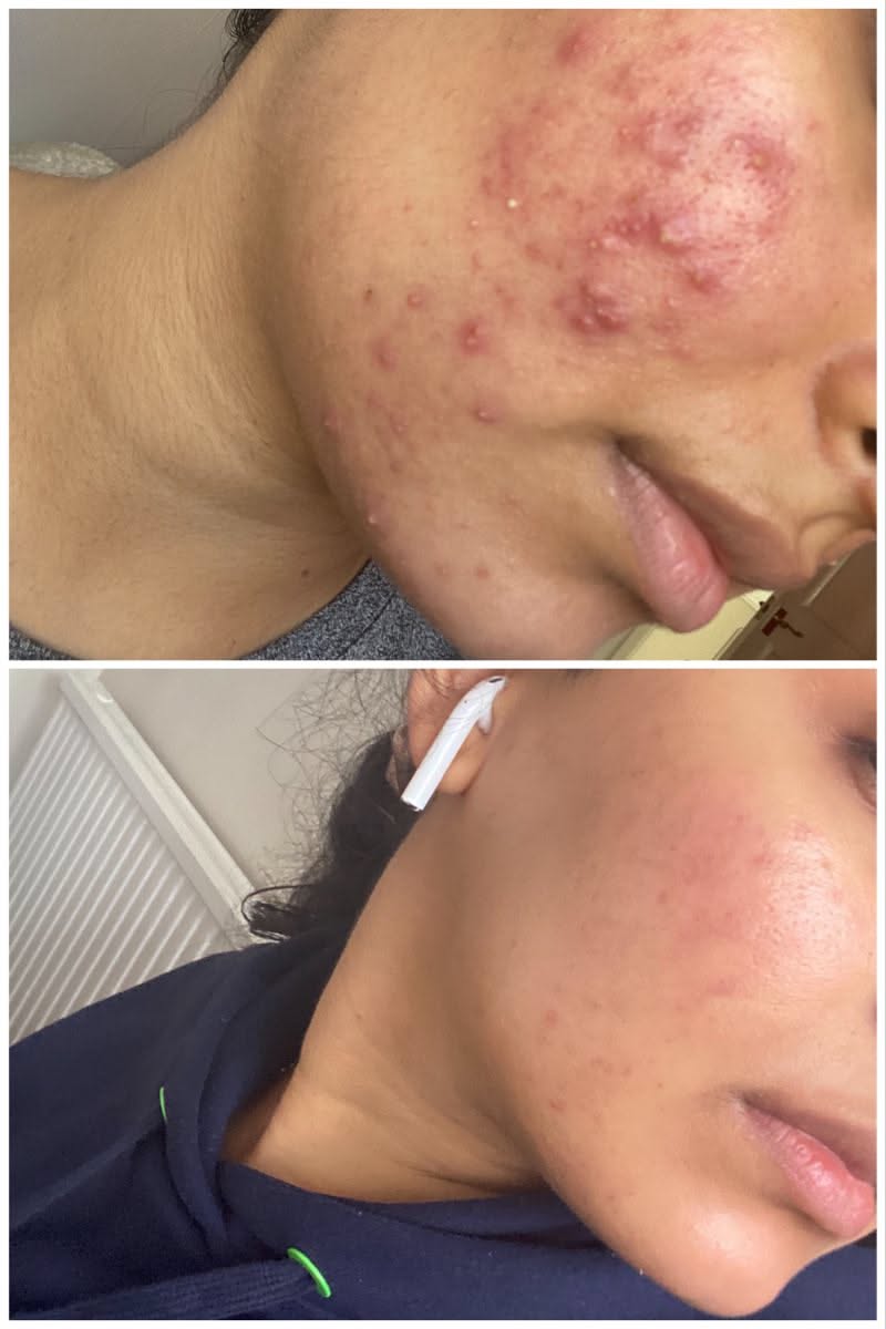 SALICYLIC ACNE CLEANING CLEANSER